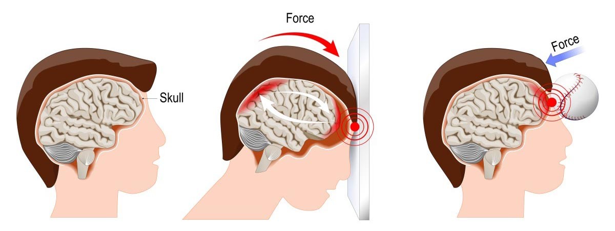 Traumatic Brain Injury traumatic-brain-injury