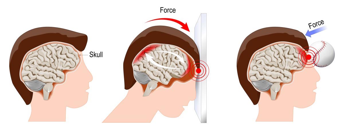 Concussion Brain Compared To Normal concussions-in-sports-hughston-clinic